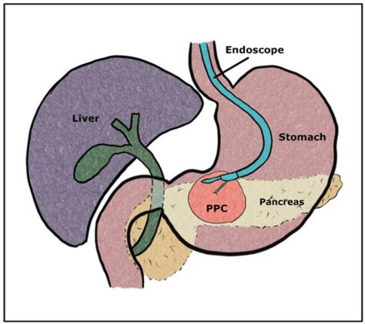 Endoscopic cystgastrostomy for pancreatic pseudocysts: An outcome assesment - ePrints