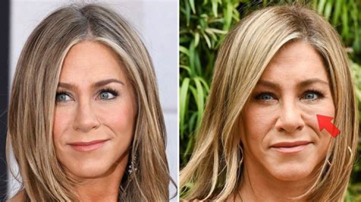 Jennifer Aniston’s Plastic Surgery: What Has She Done to Her Face?